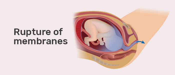 Early Rupture of Membranes: Recognizing Signs and Seeking Care