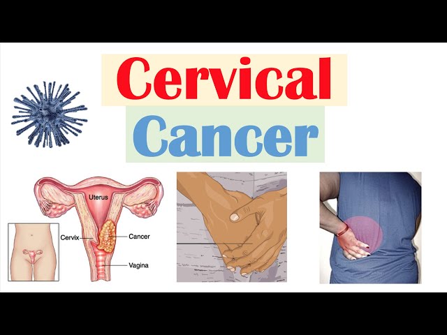 Cervical Cancer Screening: Protecting Women’s Health